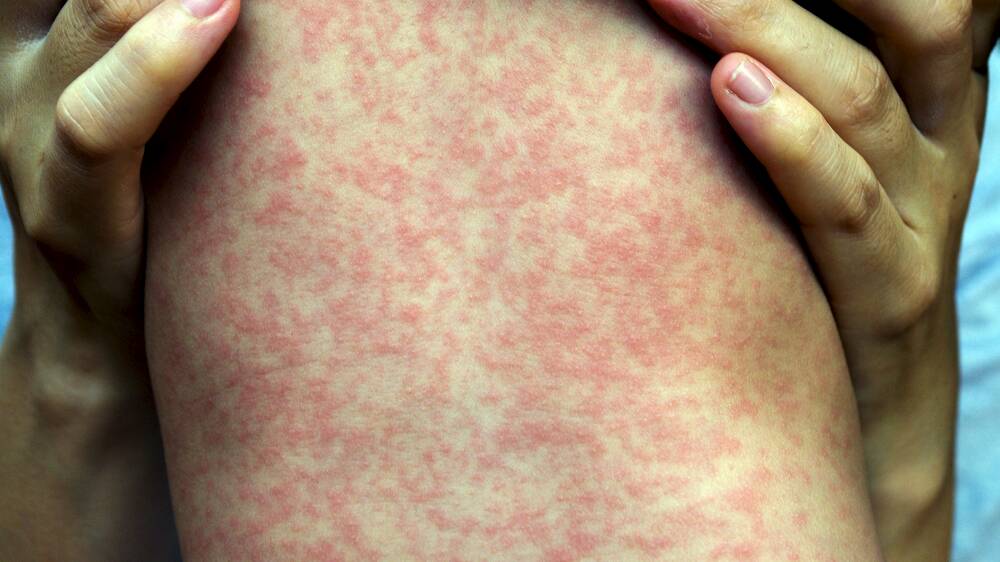  MEASLES: On rare occasions the disease can be fatal.