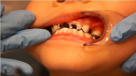 A child with tooth decay. Photo: Dental Health Services Victoria